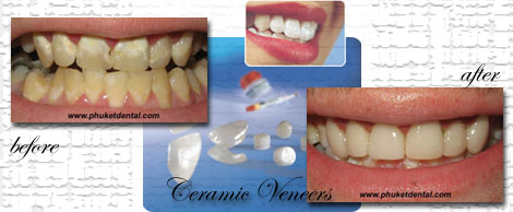 dental veneer:Phuket dental clinic,Thailand