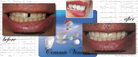 Phuket dental veneer