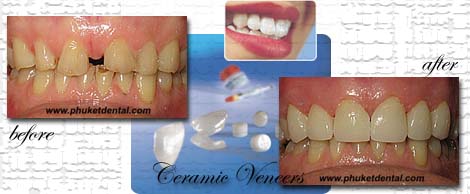 dental veneers at Phuket dental clinic,Thailand