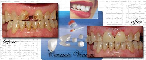 Ceramic/Porcelain Veneers by Phuket Dentist at Phuket Dental Clinic in Phuket,Thailand