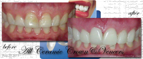 Ceramic/Porcelain Veneers by Phuket Dentist at Phuket Dental Clinic in Phuket,Thailand