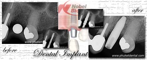 dental implant