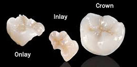 Ceramic/porcelain inlays&onlays:Phuket dental clinic,Thailand