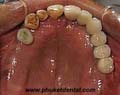 dental implant