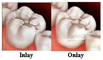 Ceramic/porcelain inlays&onlays:Phuket dental clinic,Thailand