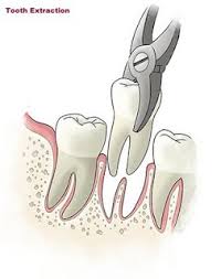 Tooth extraction:Phuket dental clinic,Thailand